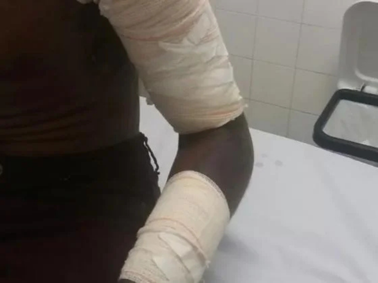 Briga de casal termina com mulher queimada e homem esfaqueado na zona rural de Ji-Paraná