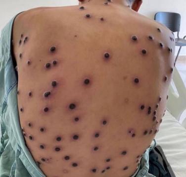 Rondônia confirma primeiro caso de mpox em Porto Velho; dois casos suspeitos seguem em investigação