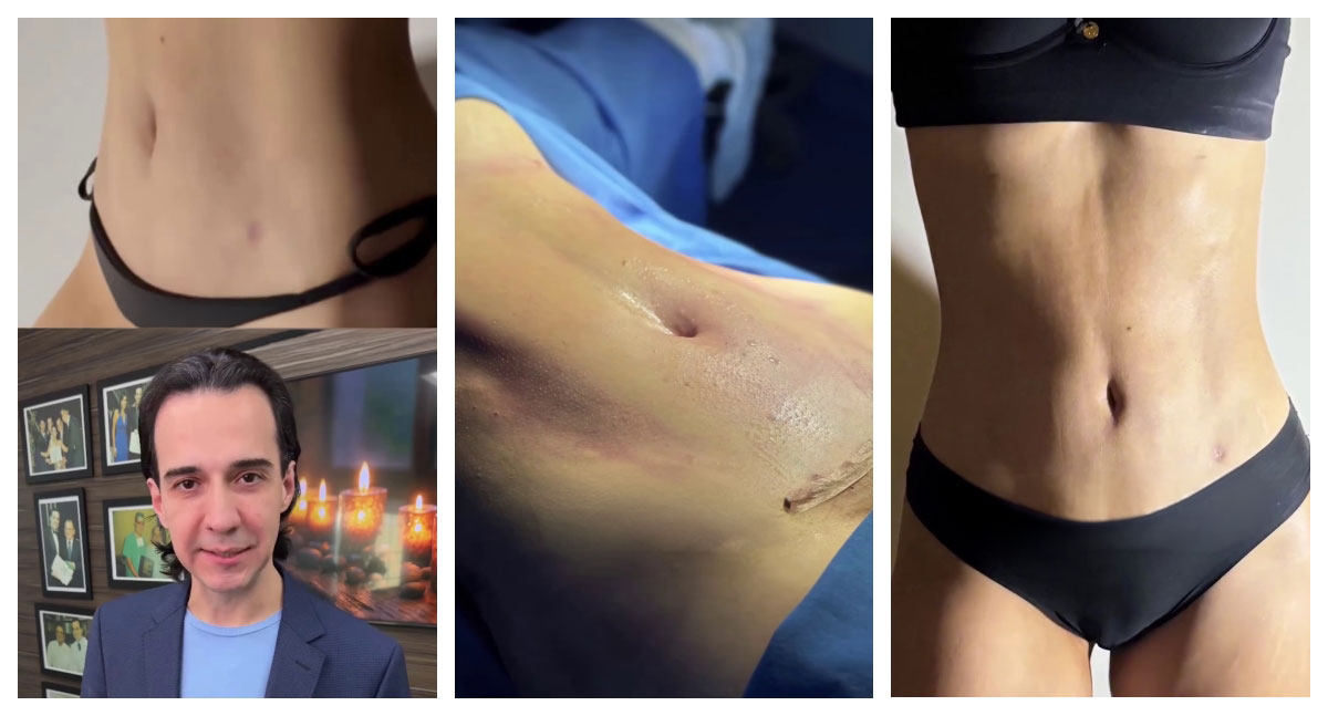 Dr. Marcelo Almeida explica abdominoplastia com cicatriz reduzida