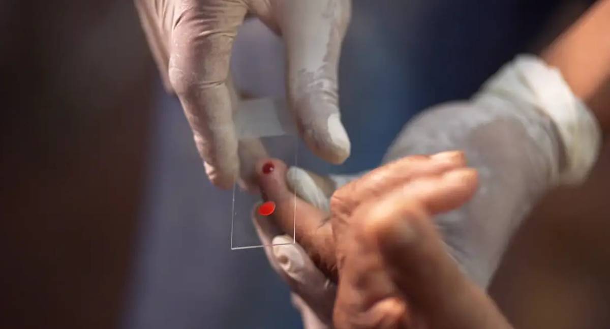 SUS inicia uso de novo tratamento em dose única contra malária infantil